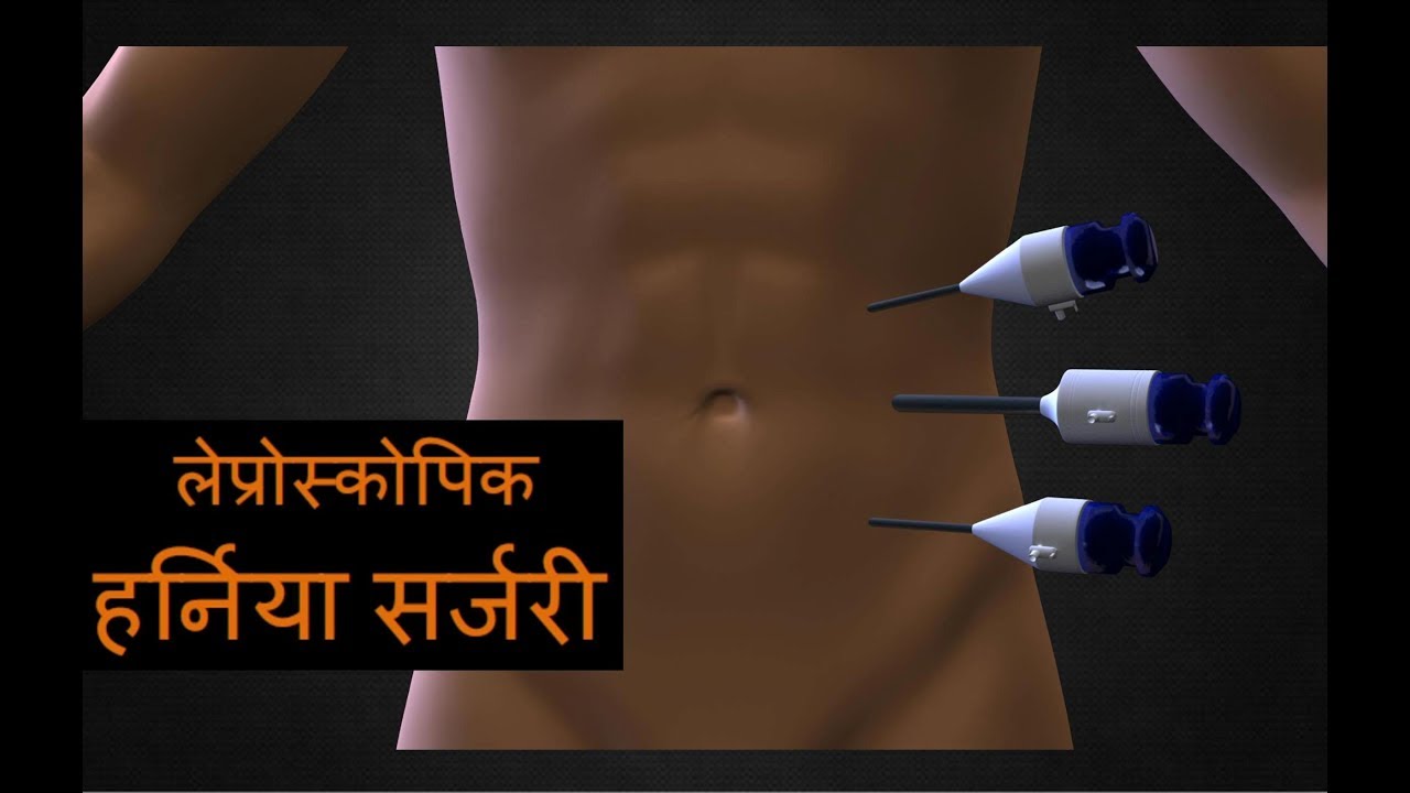 लैप्रोस्कोपिक अम्बिलिकल हर्निया सर्जरी Best Laparoscopic Incisional or Umbilical Hernia  In India