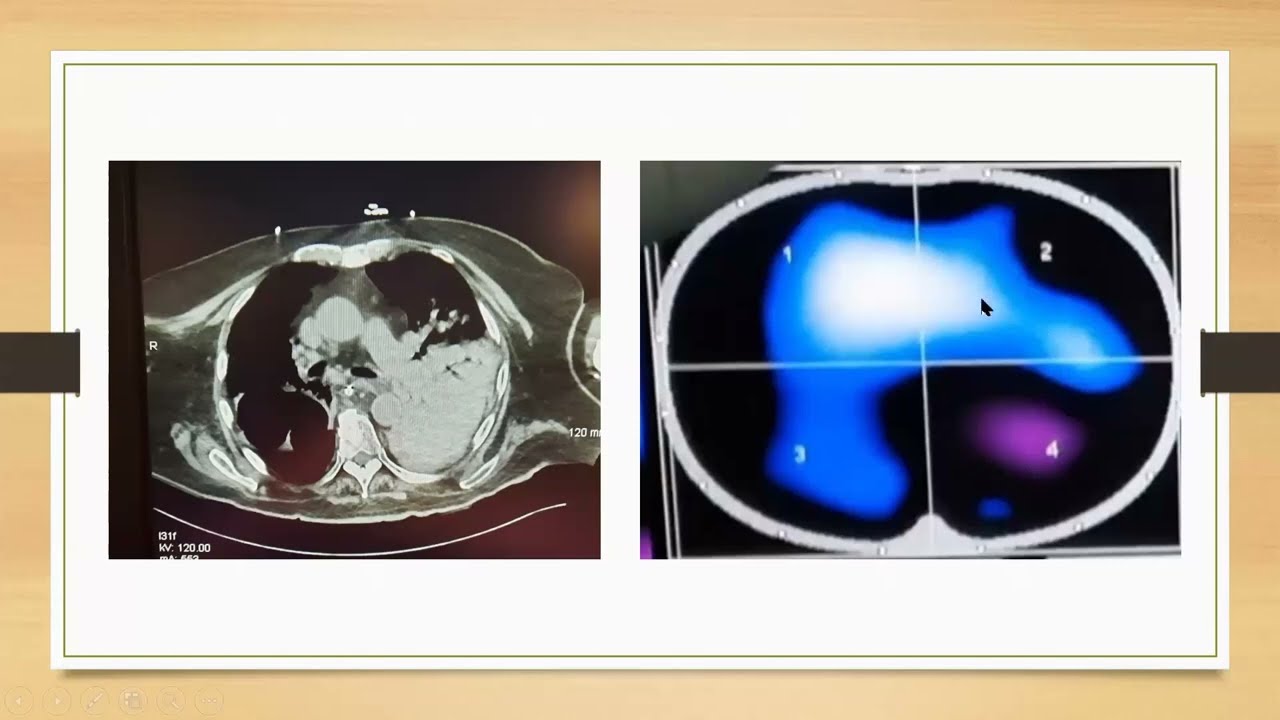 Electrical Impedance Tomography Guided Mechanical Ventilation
