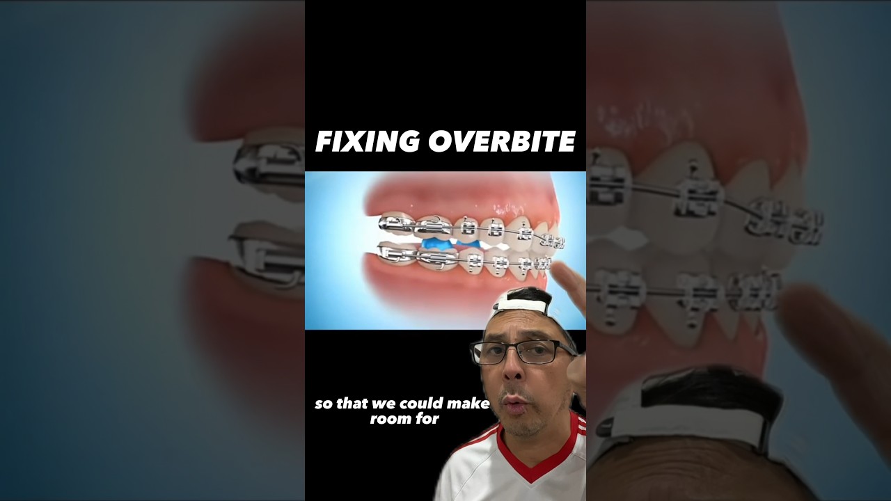 How to Properly Fix an Overbite with Braces | View Mobile Dental #shorts