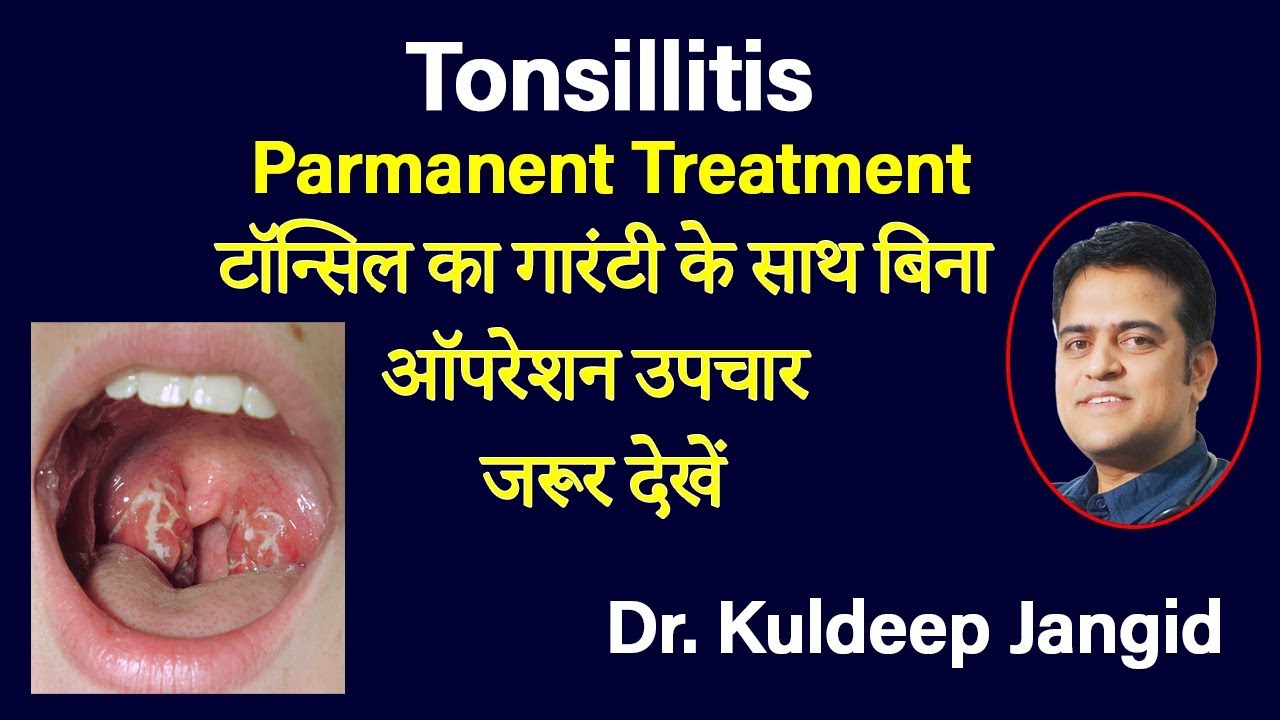 Best Treatment of Tonsillitis without Operation | टॉन्सिल्लिटिस का बिना ऑपरेशन ट्रीटमेंट |