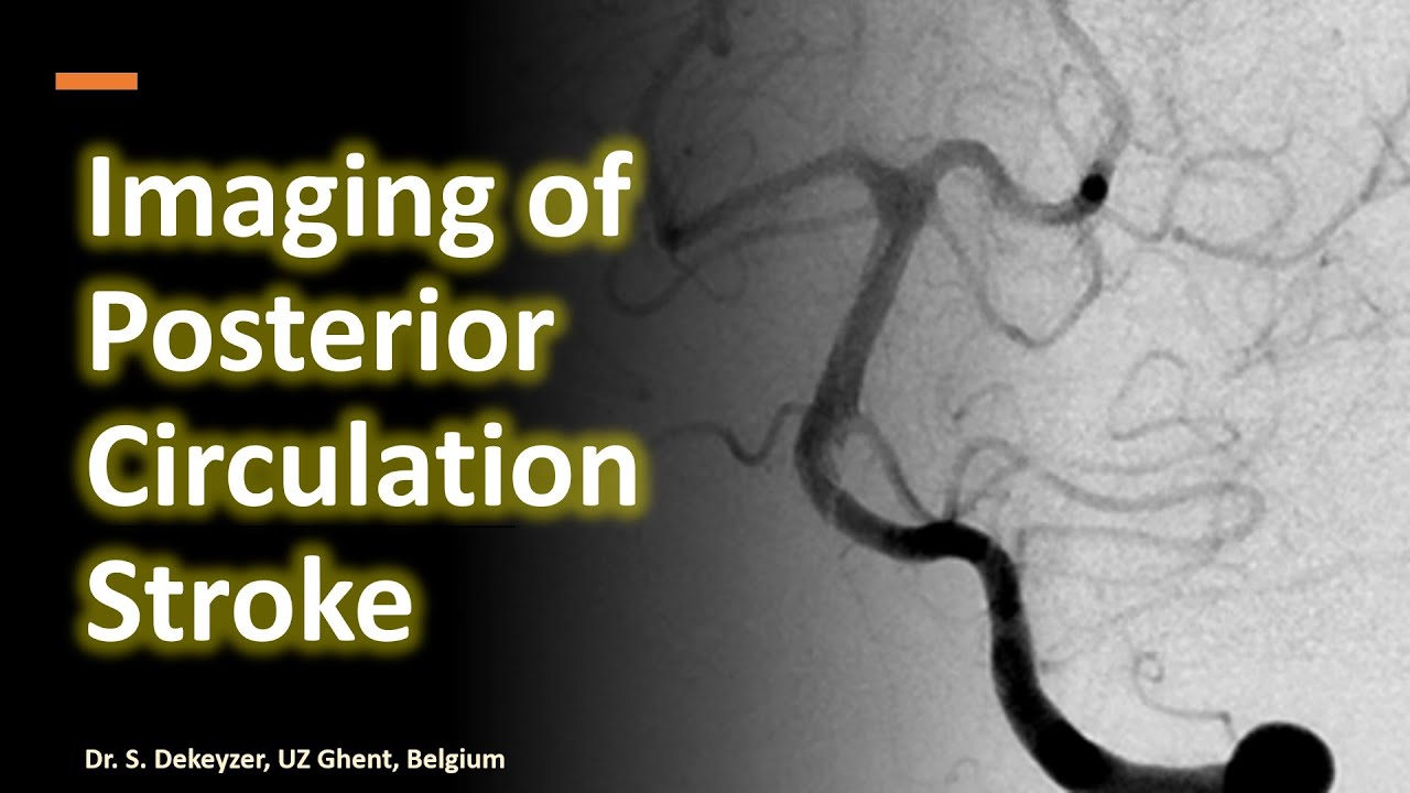 Basilar artery thrombosis and beyond - Imaging of posterior circulation stroke.