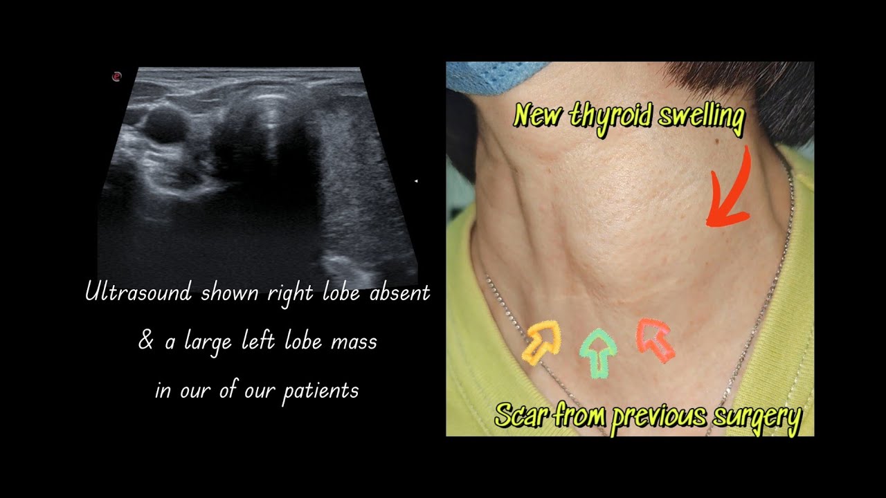 Recurrent thyroid swelling post thyroidectomy PYT2