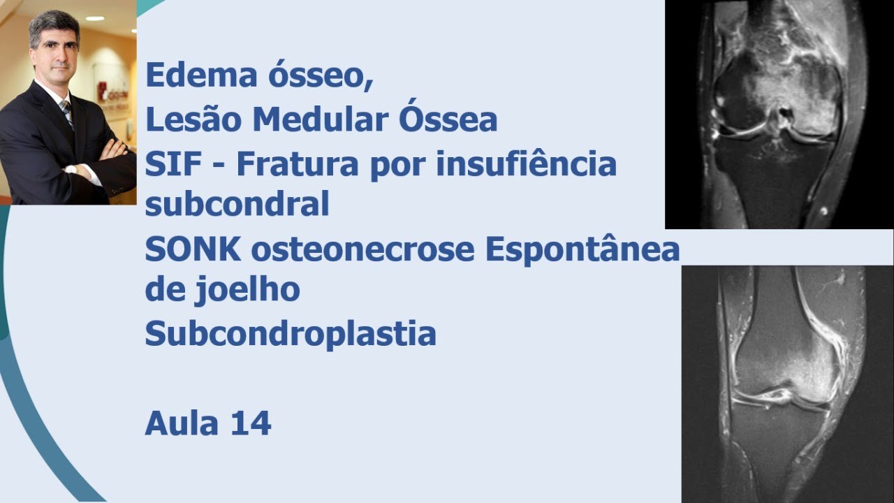Edema Osseo e Subcondroplastia