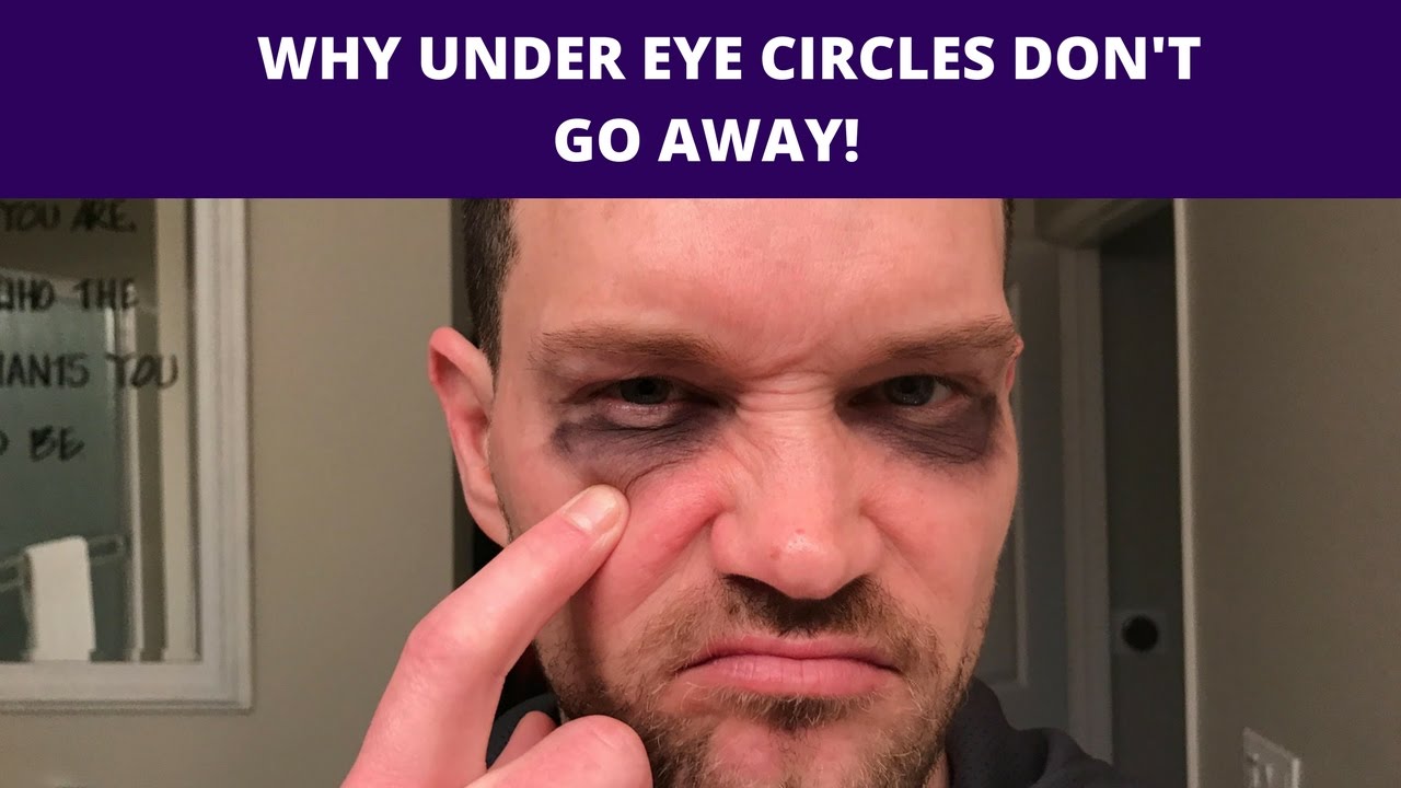 WHY UNDER EYE CIRCLES DON'T LIGHTEN OR GO AWAY