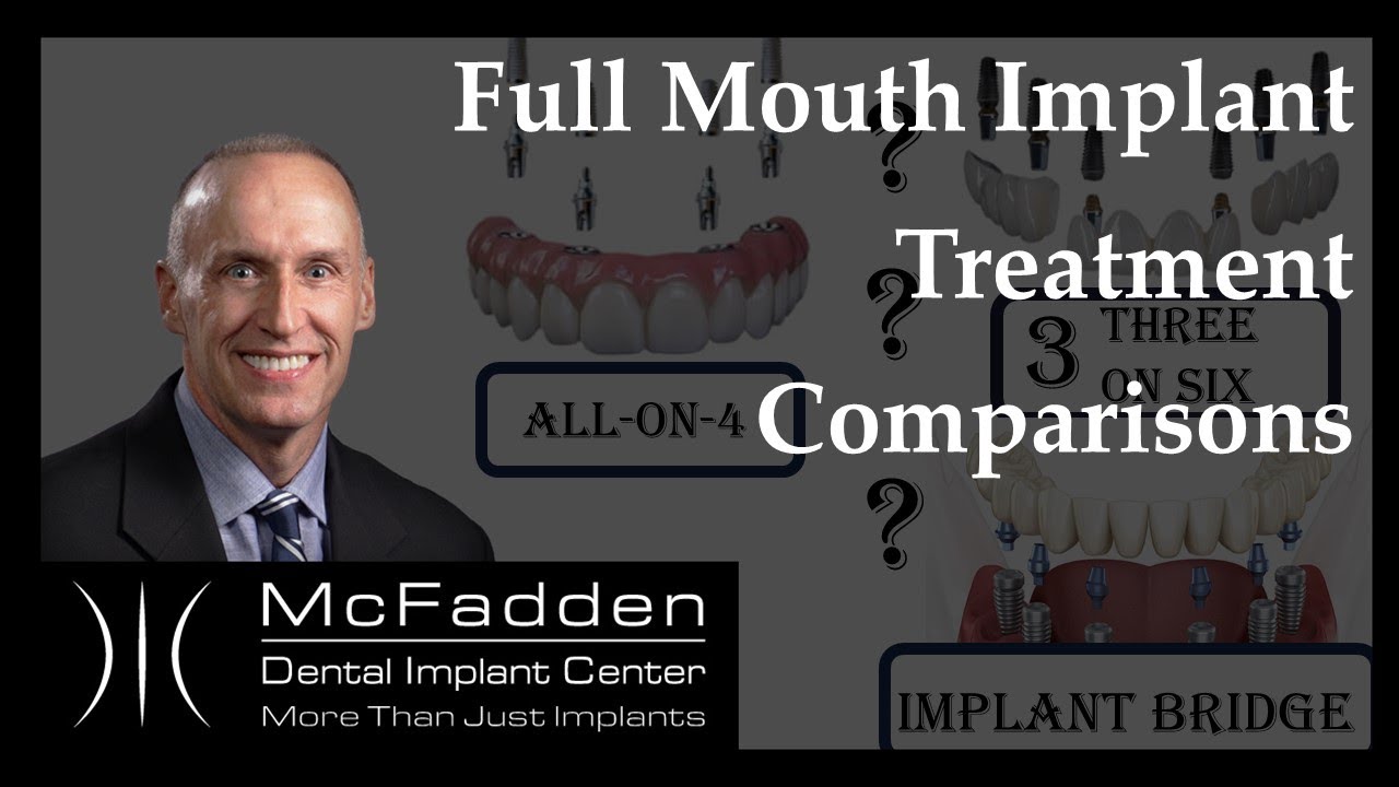 Full Mouth Implant Treatment Comparisons