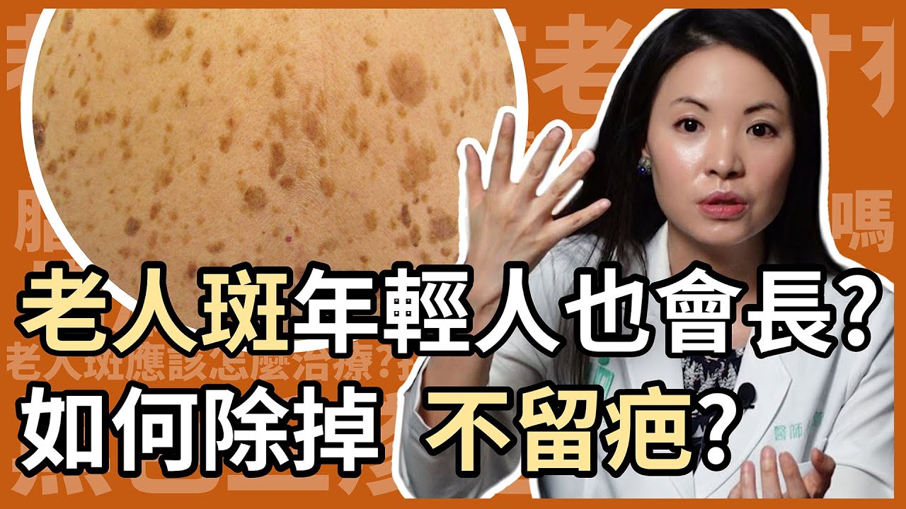 年輕人也會長老人斑？如何消除且不留疤？有人長老人斑，結果發現是大腸癌末期？就讓調皮女醫林昀萱醫師來跟大家講解，什麼是脂漏性角化症吧！