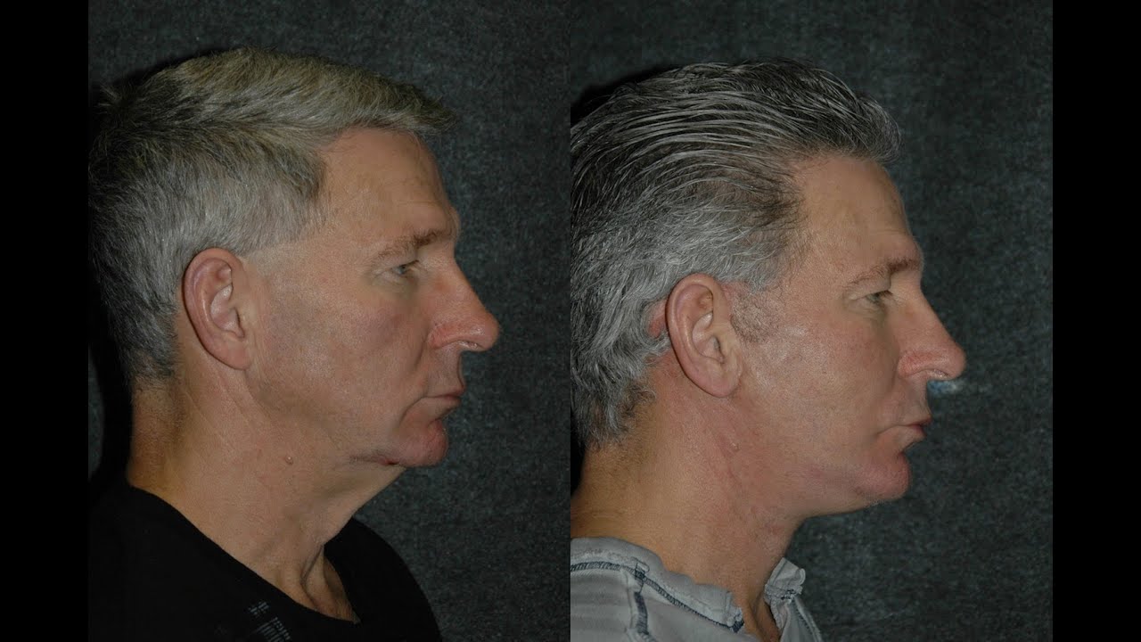 Male Facelift Before and After #faceliftformen