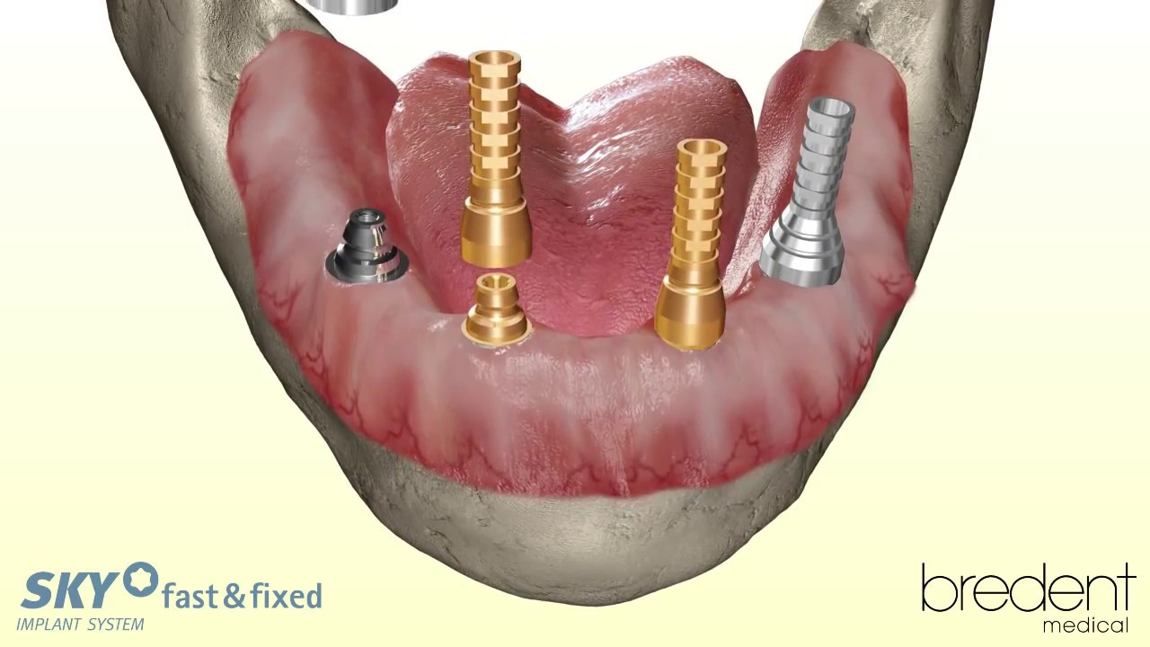 SKY fast & fixed implant system - 3D animation