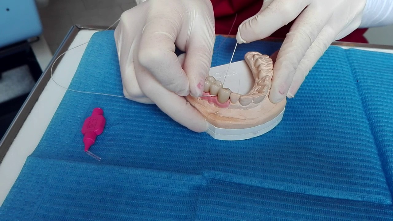Come si pulisce un ponte dentale
