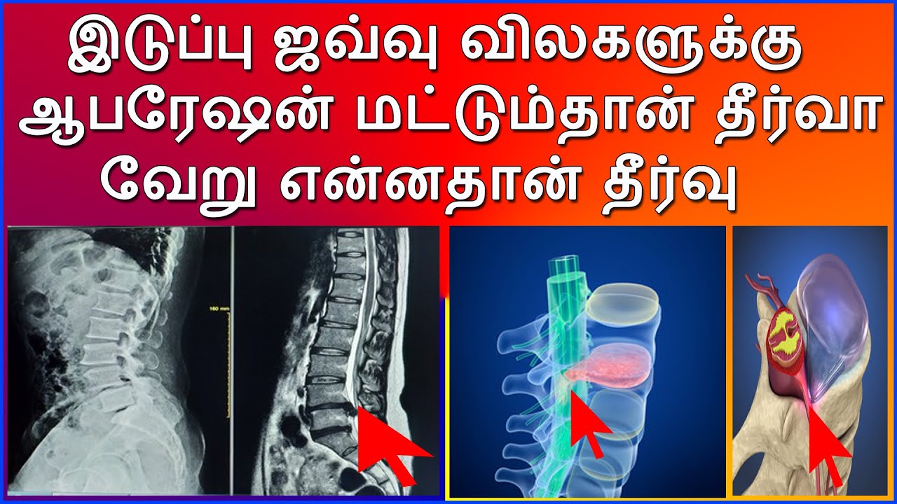 இடுப்பு ஜவ்வு விலகளுக்கு ஆபரேஷன் மட்டும்தான் தீர்வா? வேறு என்னதான் தீர்வு?