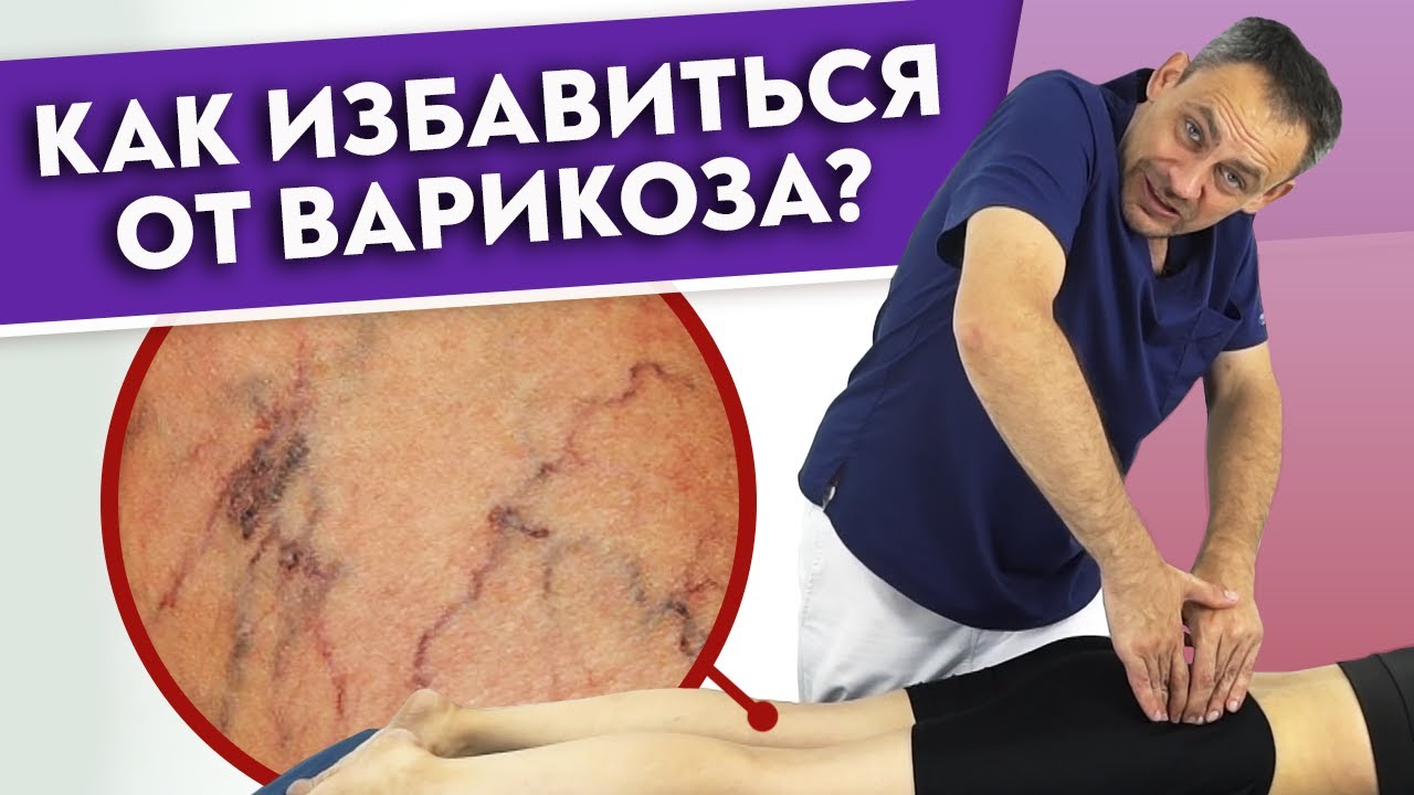 Как убрать ВАРИКОЗ? | Варикозное расширение вен — причины и лечение