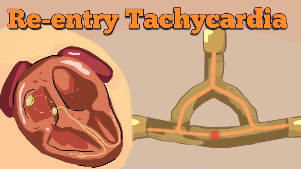 Reentry Tachycardia | AVNRT, AVRT (including WPW-syndrome)