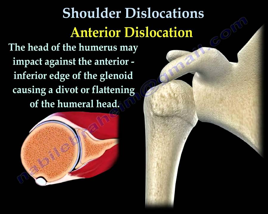 Shoulder Dislocations ,Everything You Need To Know - Dr. Nabil Ebraheim