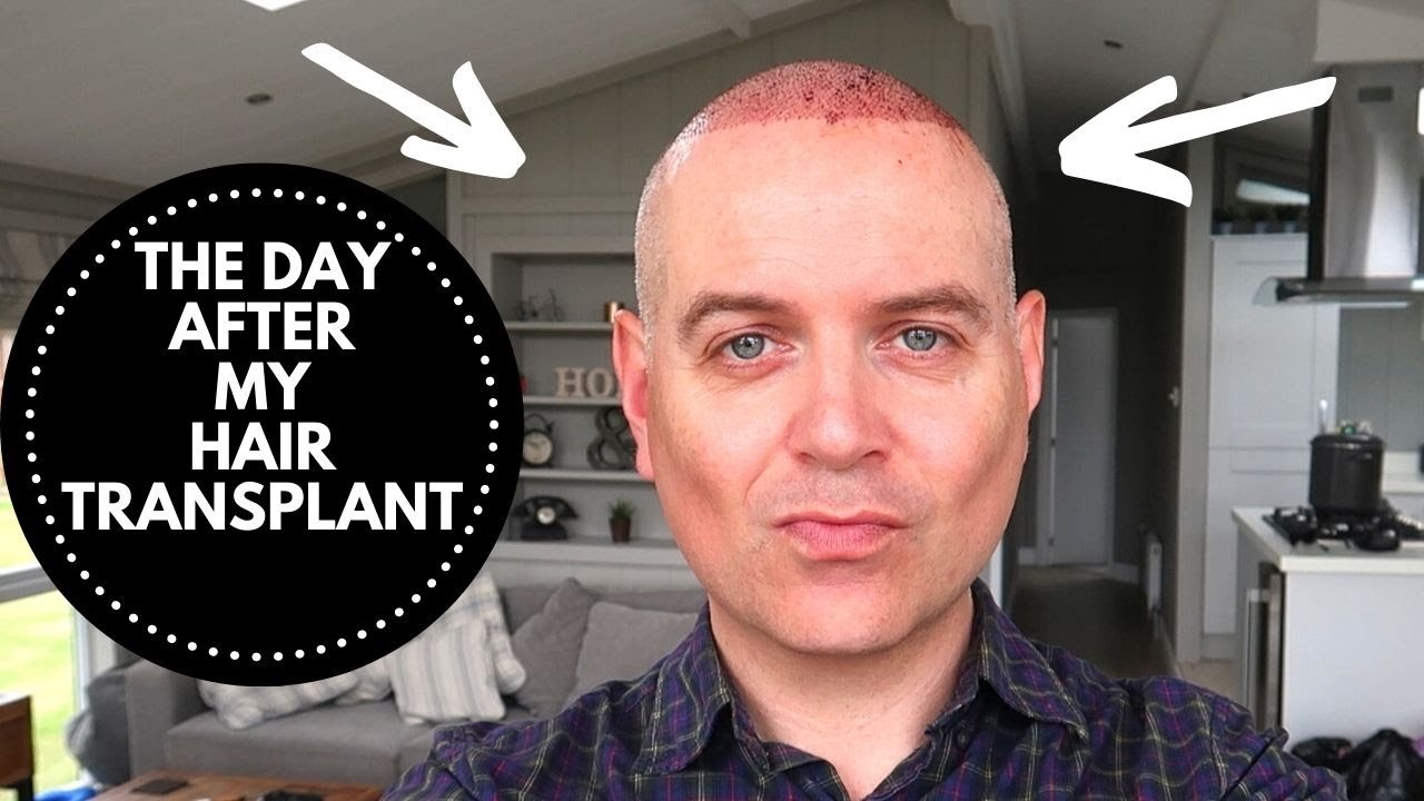 DAY 1 POST HAIR TRANSPLANT SURGERY FUE | THE LODGE GUYS