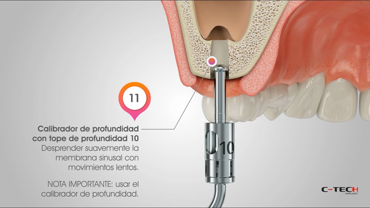 Crestal Sinus Lift - SPA