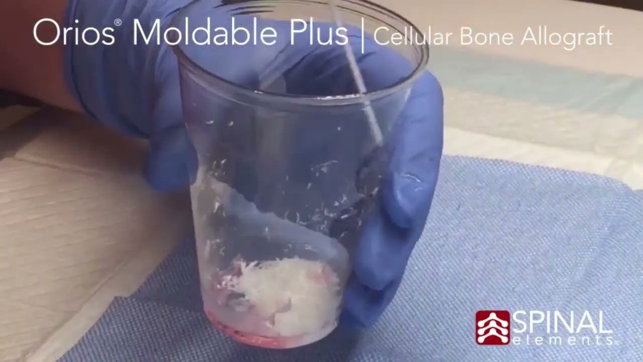 Orios Bones Graft Substitute Moldable Handling