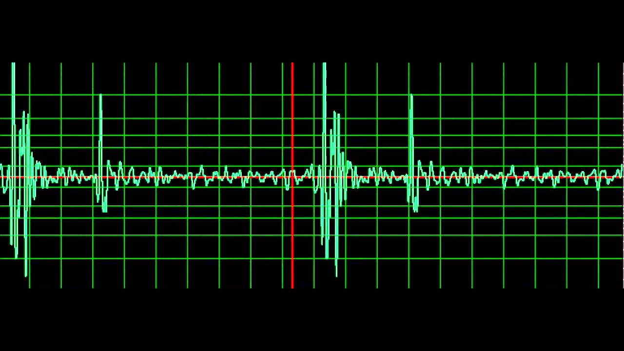 Normal Heart Sound- normal speed