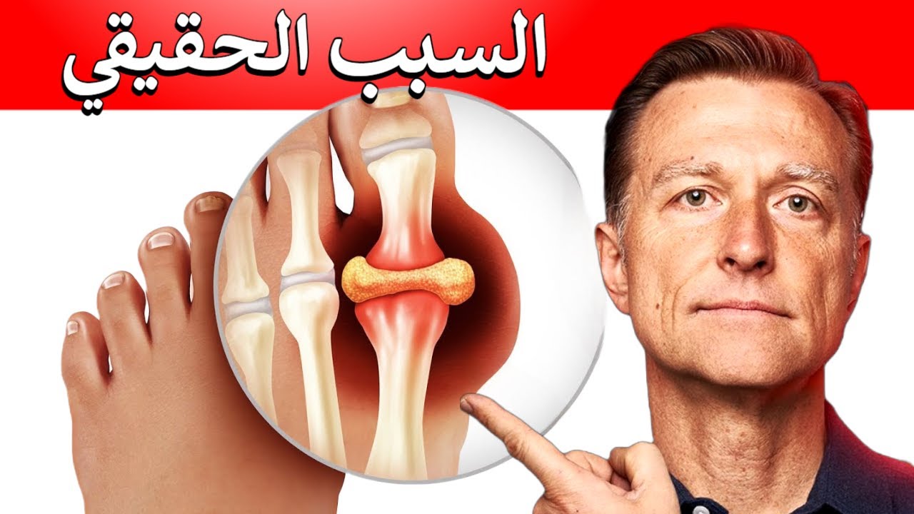 تم كشف اللغز وراء هجمات النقرس | ليس فقط حمض اليوريك