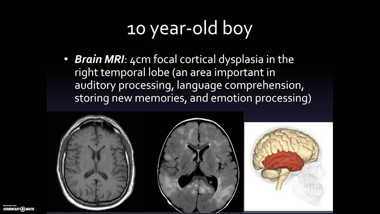 Seizures in Autism: Part 2 of 3