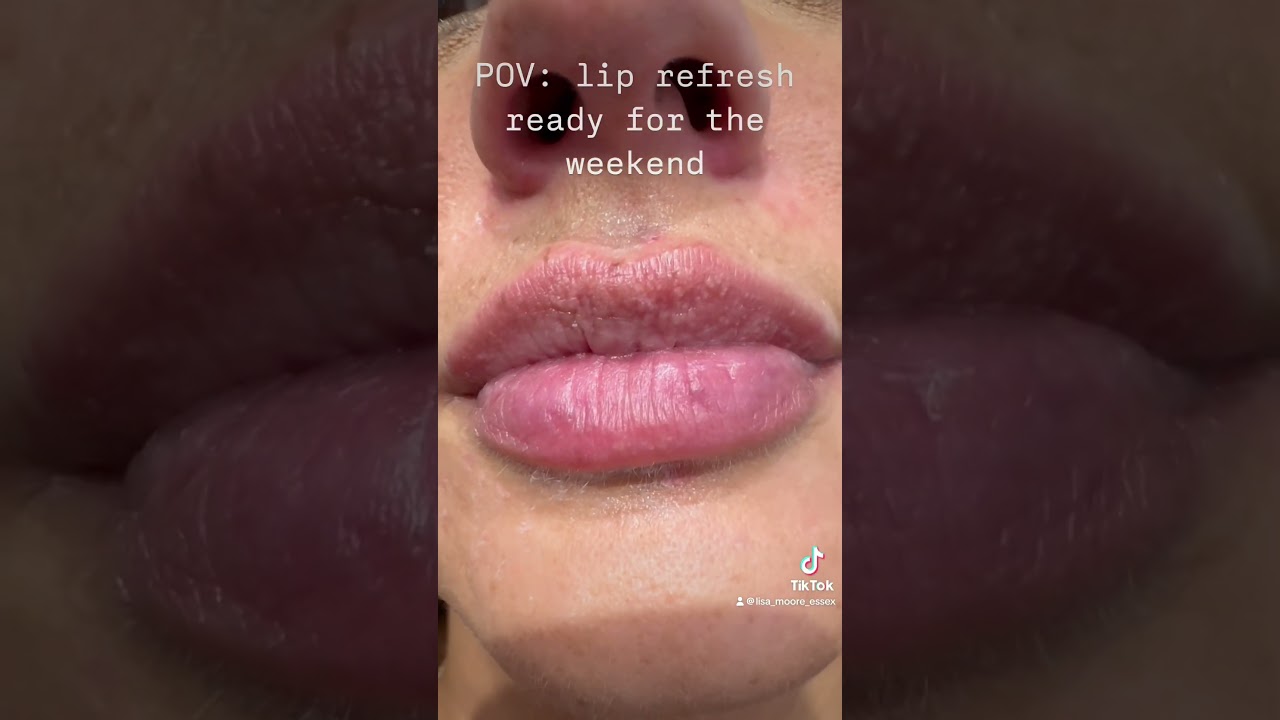 0.5ml juvederm smile to give a great lip refresh #filler #lipfiller #juvederm #dermalfillers #lips