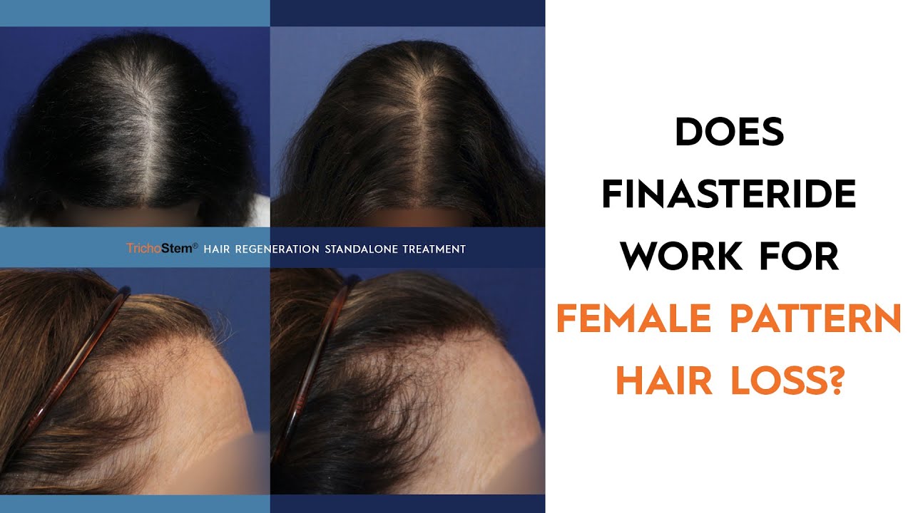 Why Finasteride is Not Usually Prescribed for Female Pattern Hair Loss