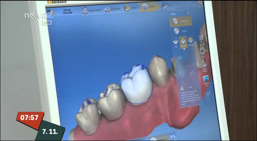 CEREC korunky - Schill Dental Clinic Praha - Nova 07 11 2014