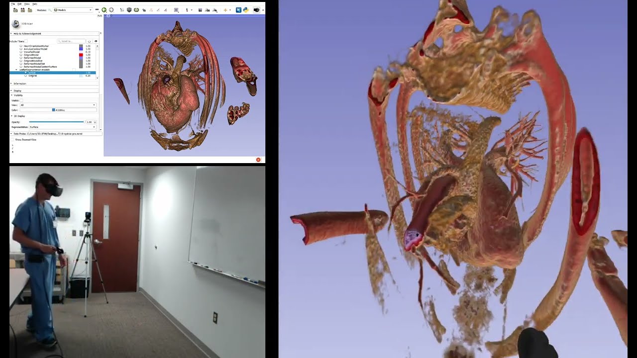 Demonstration of Pre- and Post-implant Modeling and Quantification in Virtual Reality