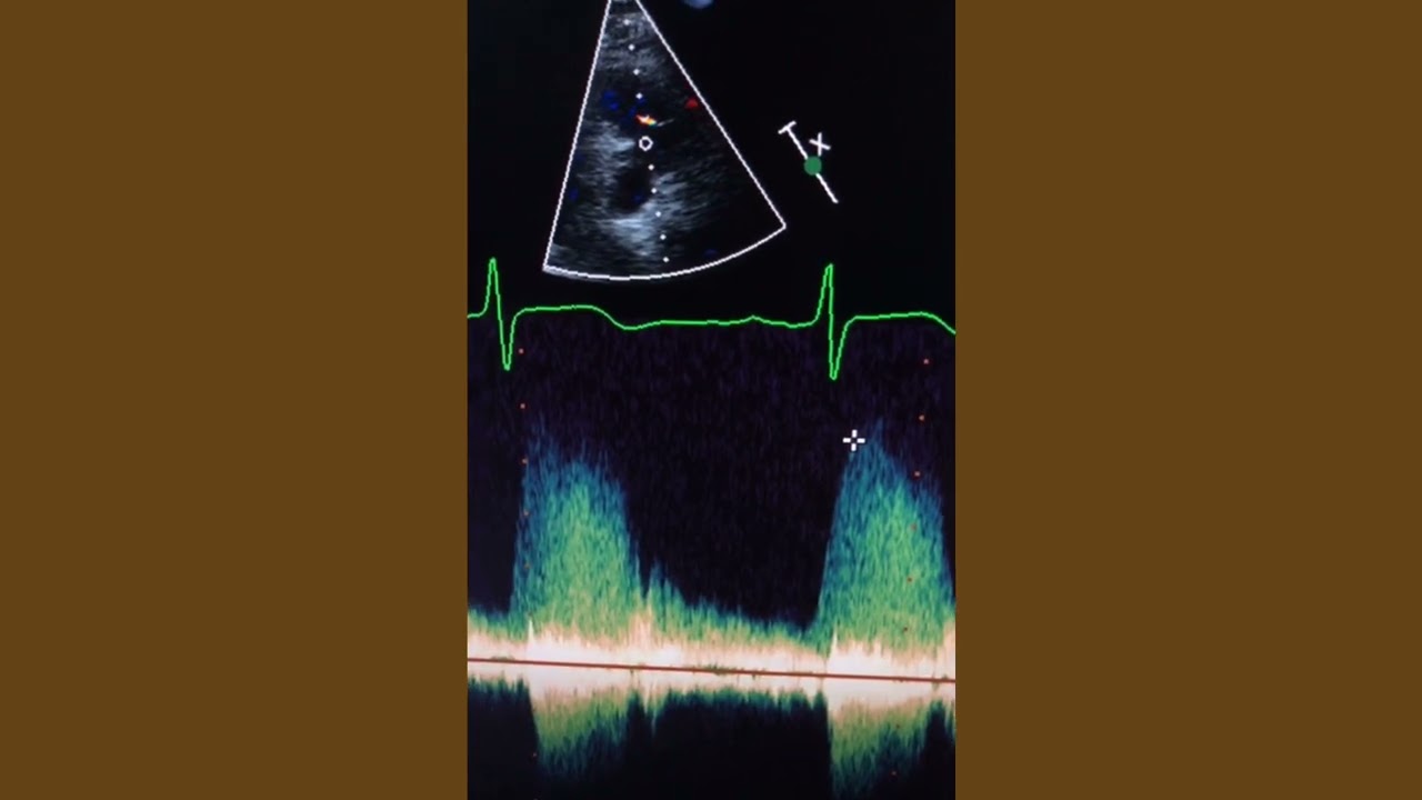 Supracristal Ventricular Septal Defect