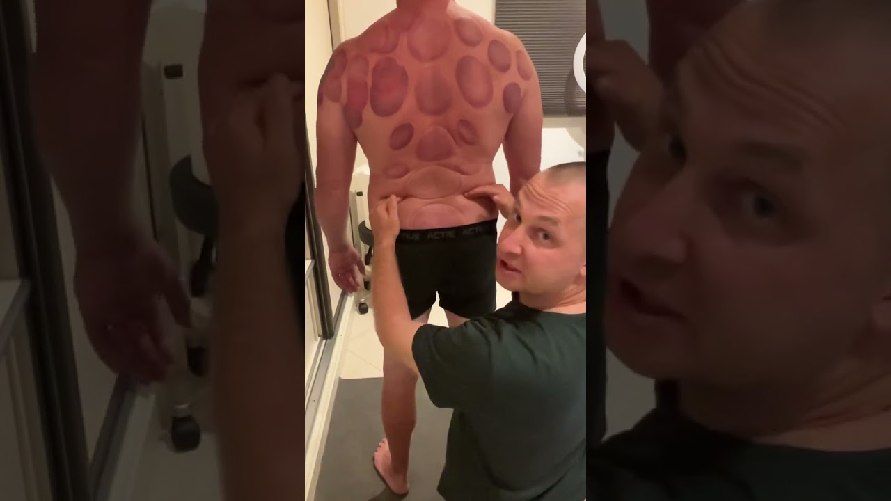 Пришел пациент с жалобами на боль в спине! В итоге у него оказался перекос таза.