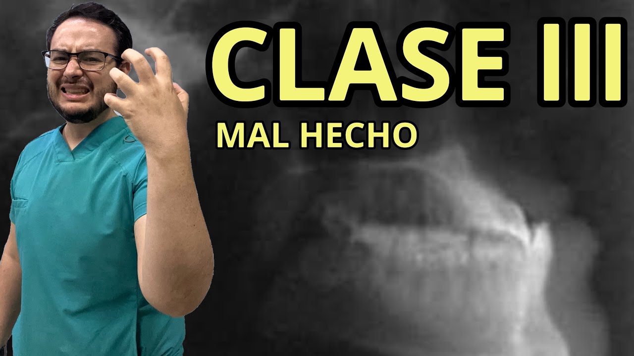 Clase III Mal Diagnosticado. Dr Leonel Santos Ortodoncia YouTube