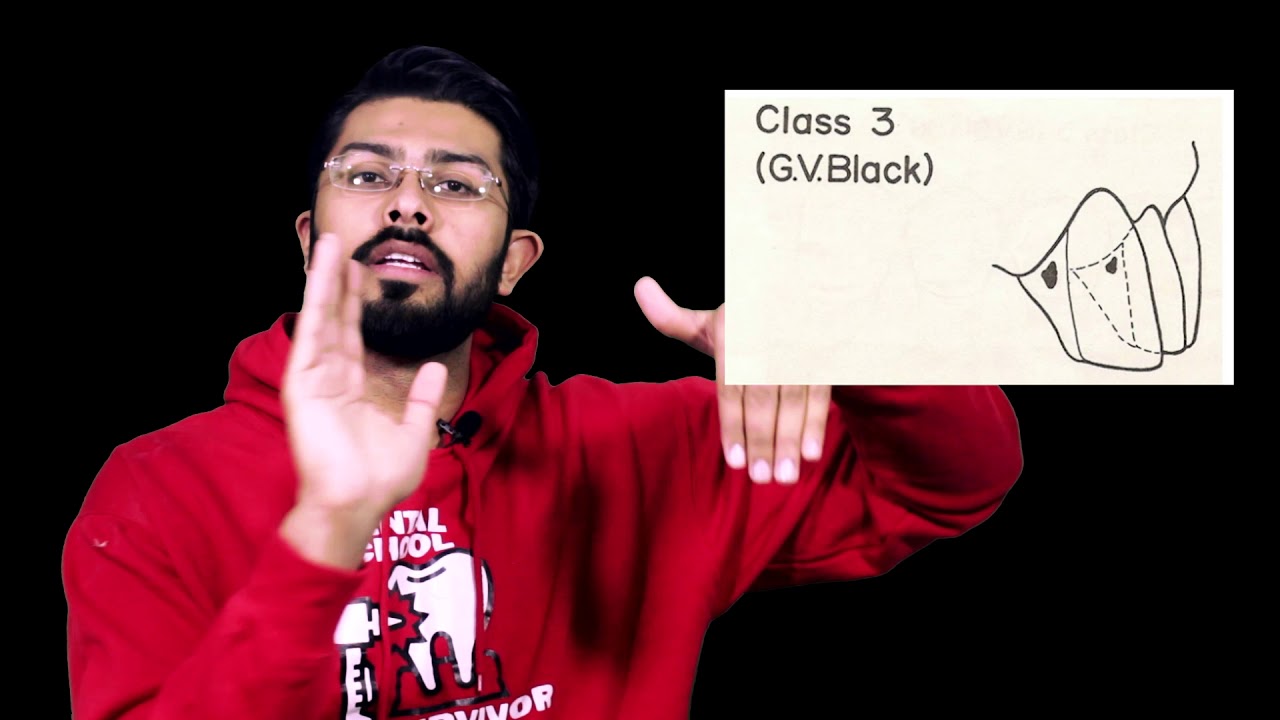 Classifications of Dental Caries (G.V. Black's Classification)