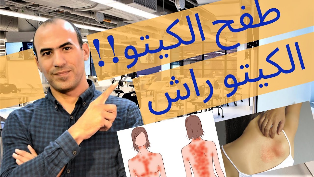الكيتو راش اسبابه و كيفية علاجه - طفح الكيتو-