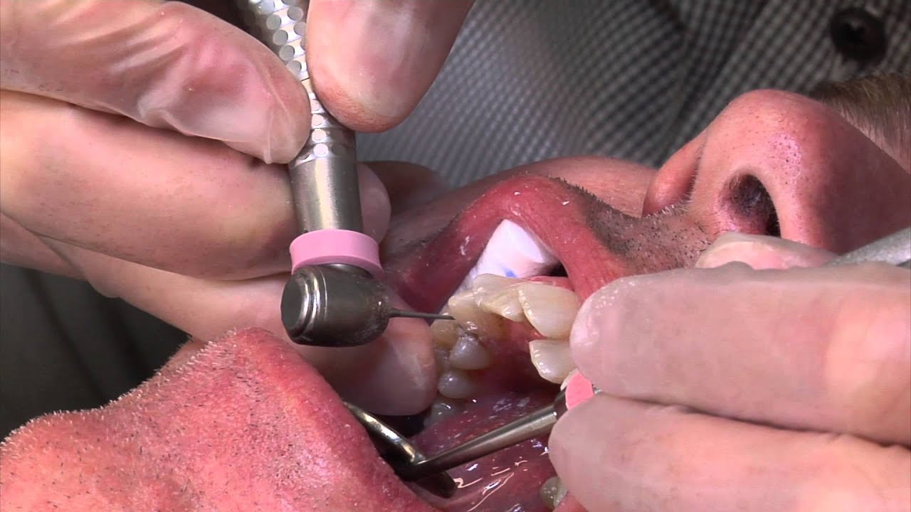 Invisalign - Part 2: Interproximal Reduction