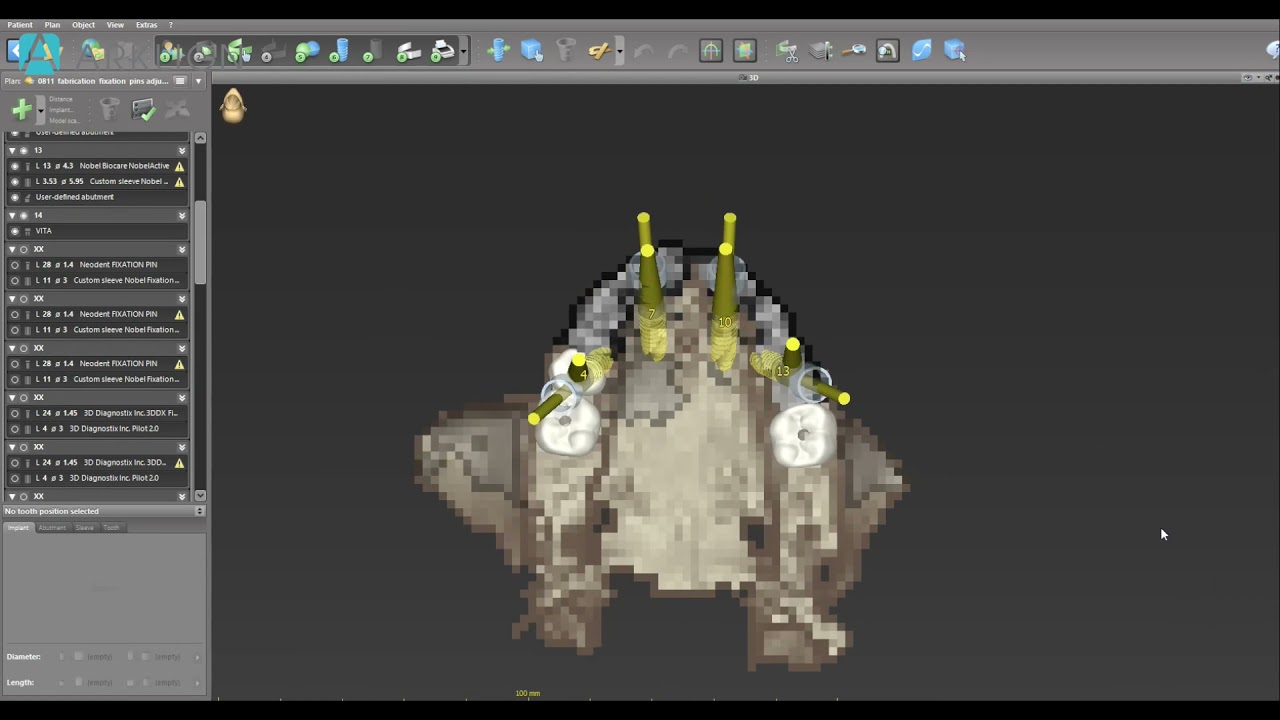 Stackable surgical guide from Arklign
