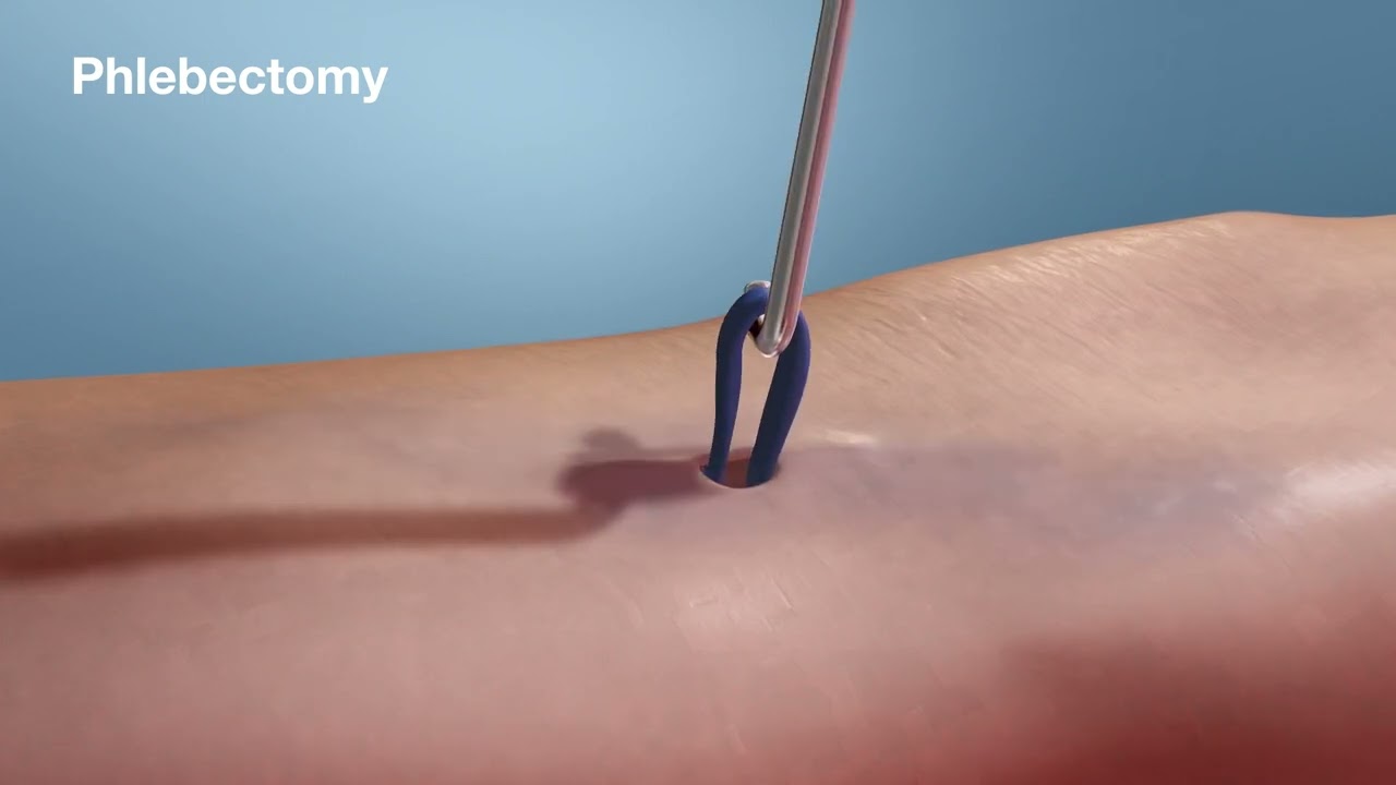 Varicose Vein Treatment Options