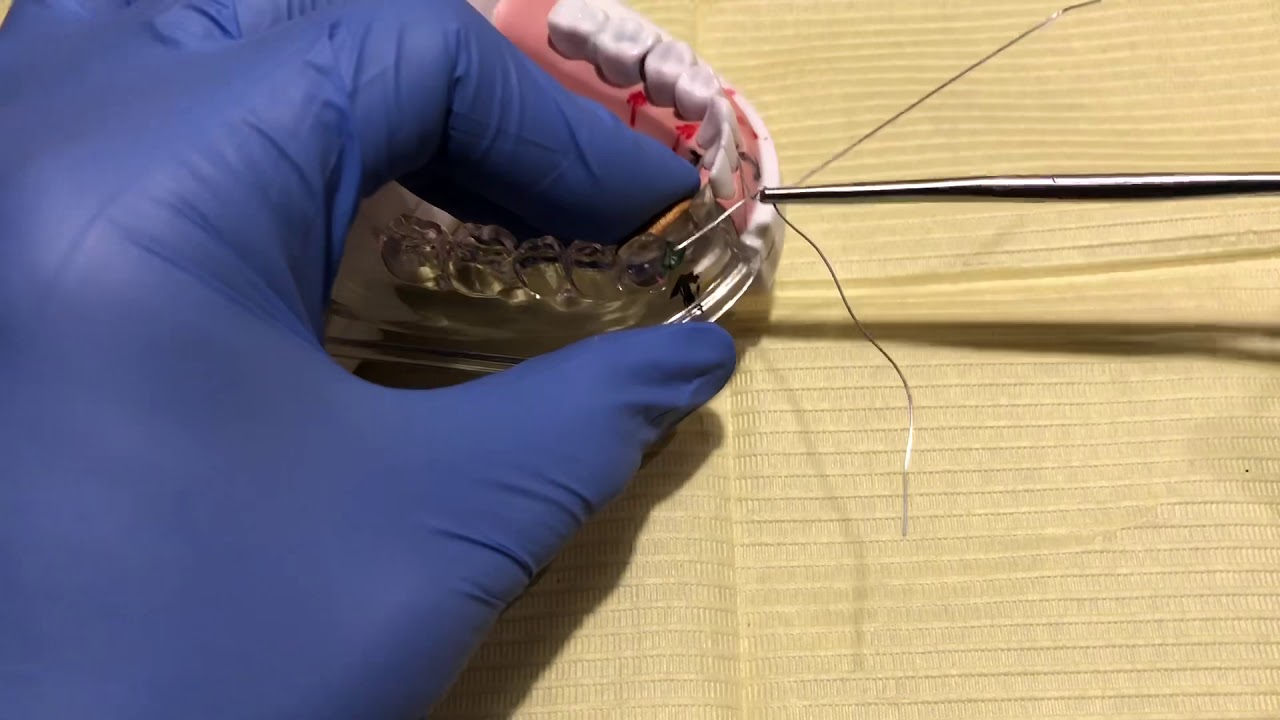 Mandibular Jaw Fracture - Bridal Wiring Technique