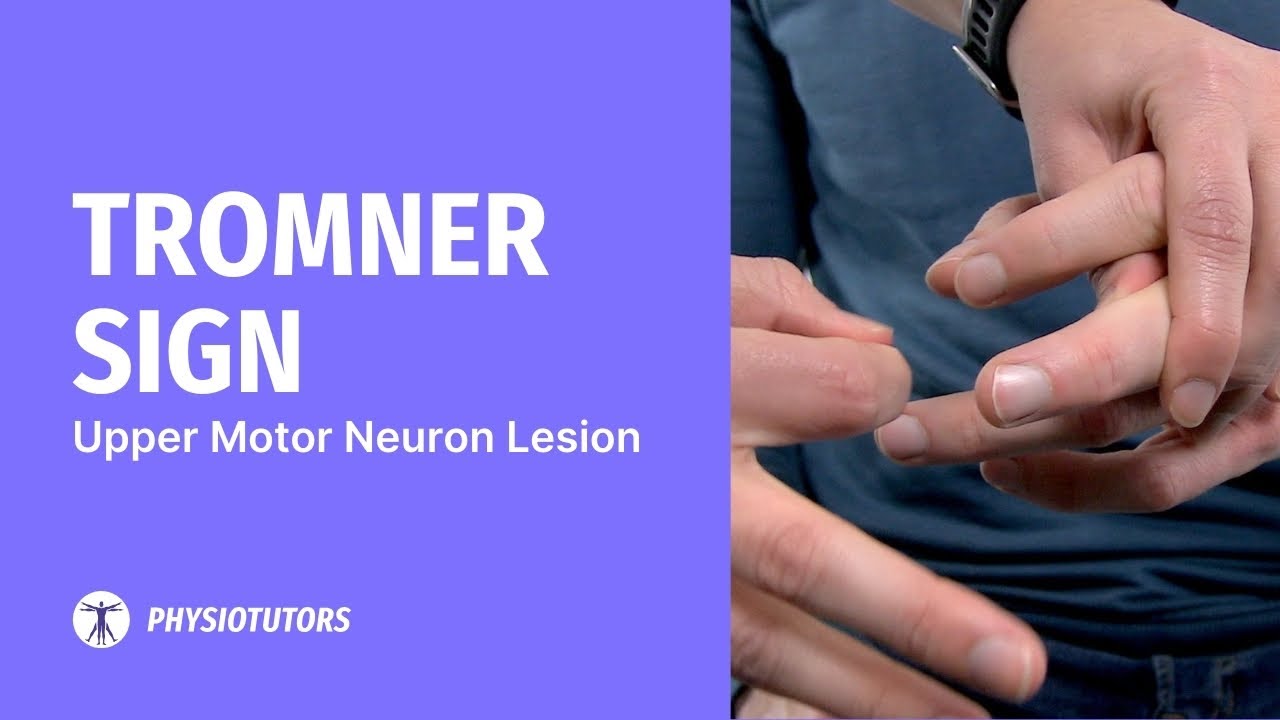 Tromner Sign | Upper Motor Neuron Lesion / Degenerative Cervical Myelopathy