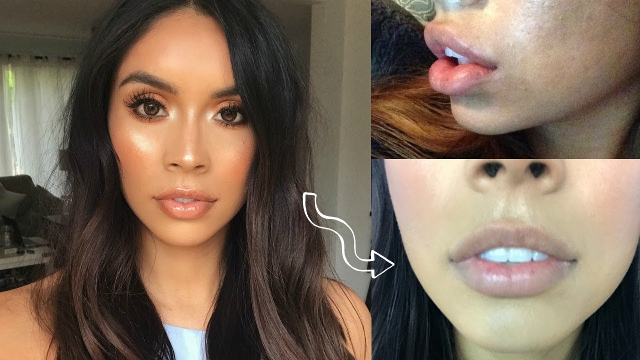 1 Year With Lip Fillers - Is It Worth It? | Maritza Mejia