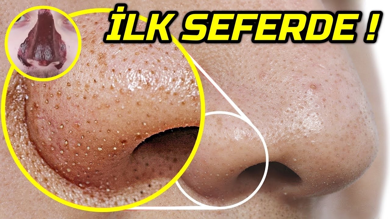 İlk Seferde Şok Sonu&ccedil;! ANINDA G&Ouml;ZENEK KAPATICI YOK EDİCİ Y&uuml;z Cilt Maskesi │ G&uuml;zellik Bakım