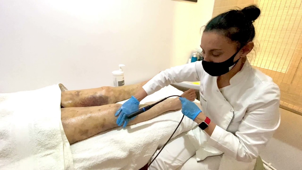 TRATAMIENTO POSTOPERATORIO DE LIPEDEMA CON INDIBA®️