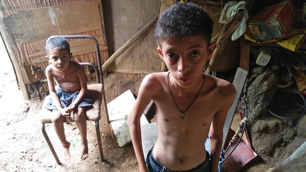 Hambre en Venezuela: el drama de la severa desnutrición infantil