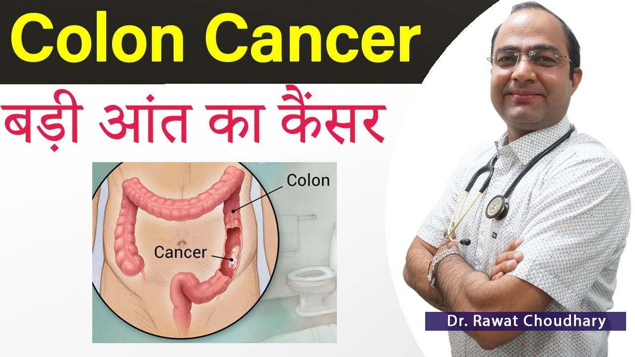 Colon Cancer Best Treatment | बड़ी आंत के कैंसर का इलाज | Large Intestine Cancer
