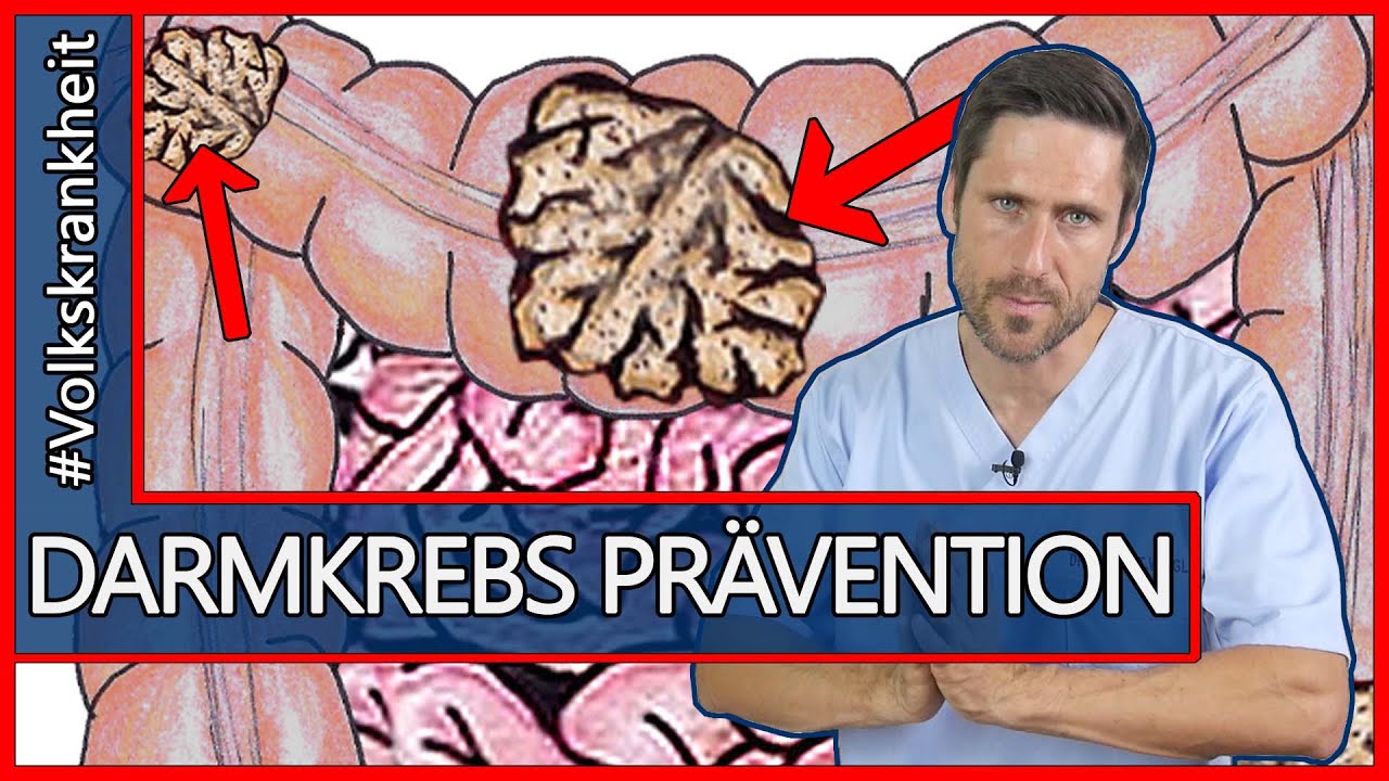 Volkskrankheit Darmkrebs: Wussten Sie das? Die richtige Vorsorge & Frühererkennung vom Kolonkarzinom