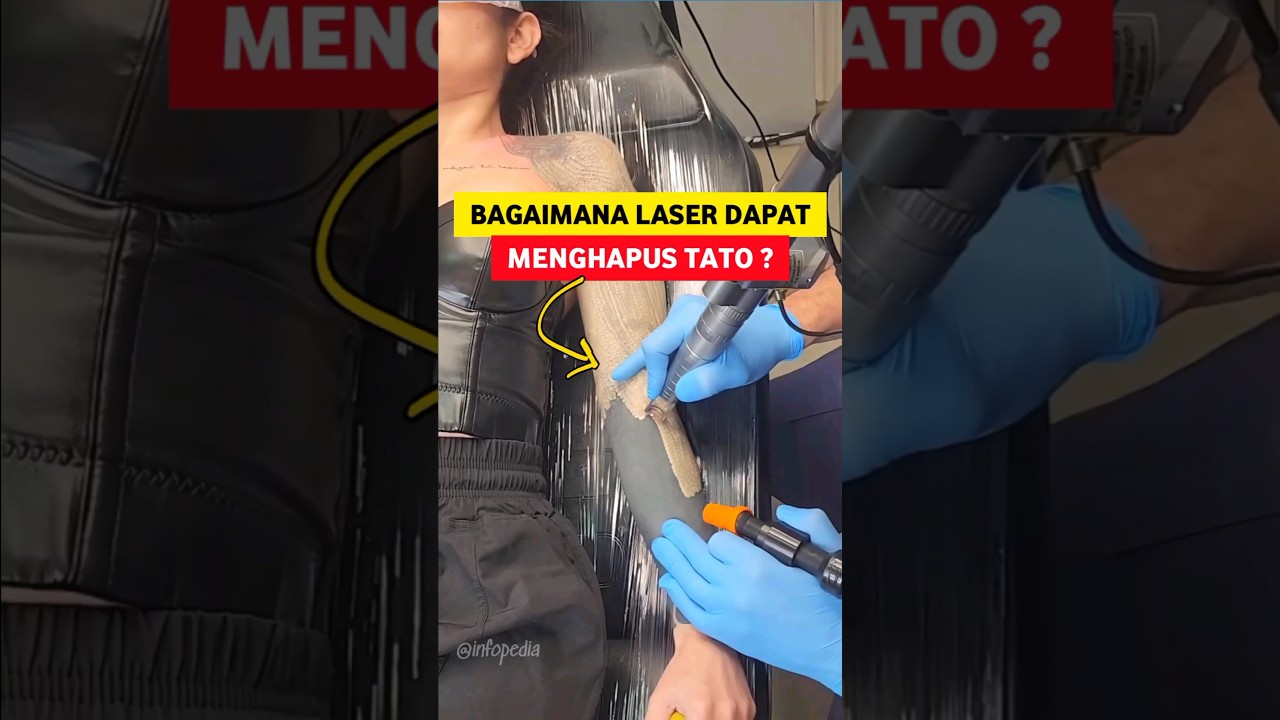 Cara Kerja Laser Menghapus Tato
