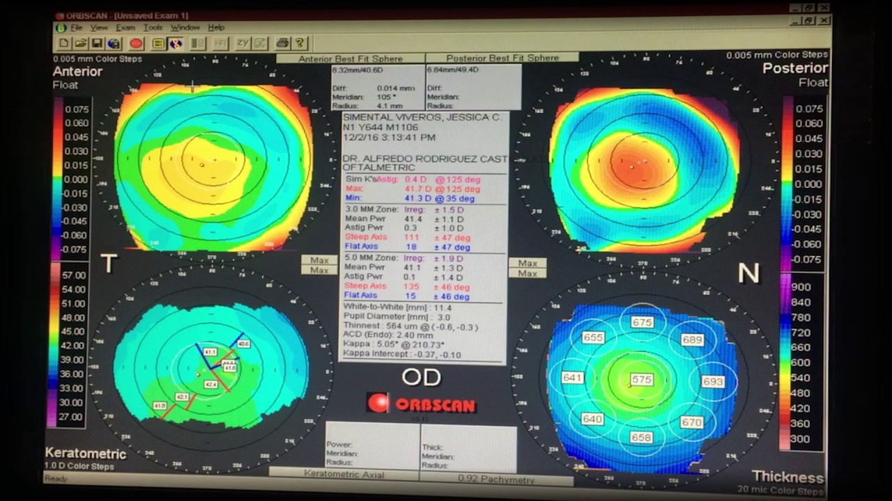 Topografía Corneal