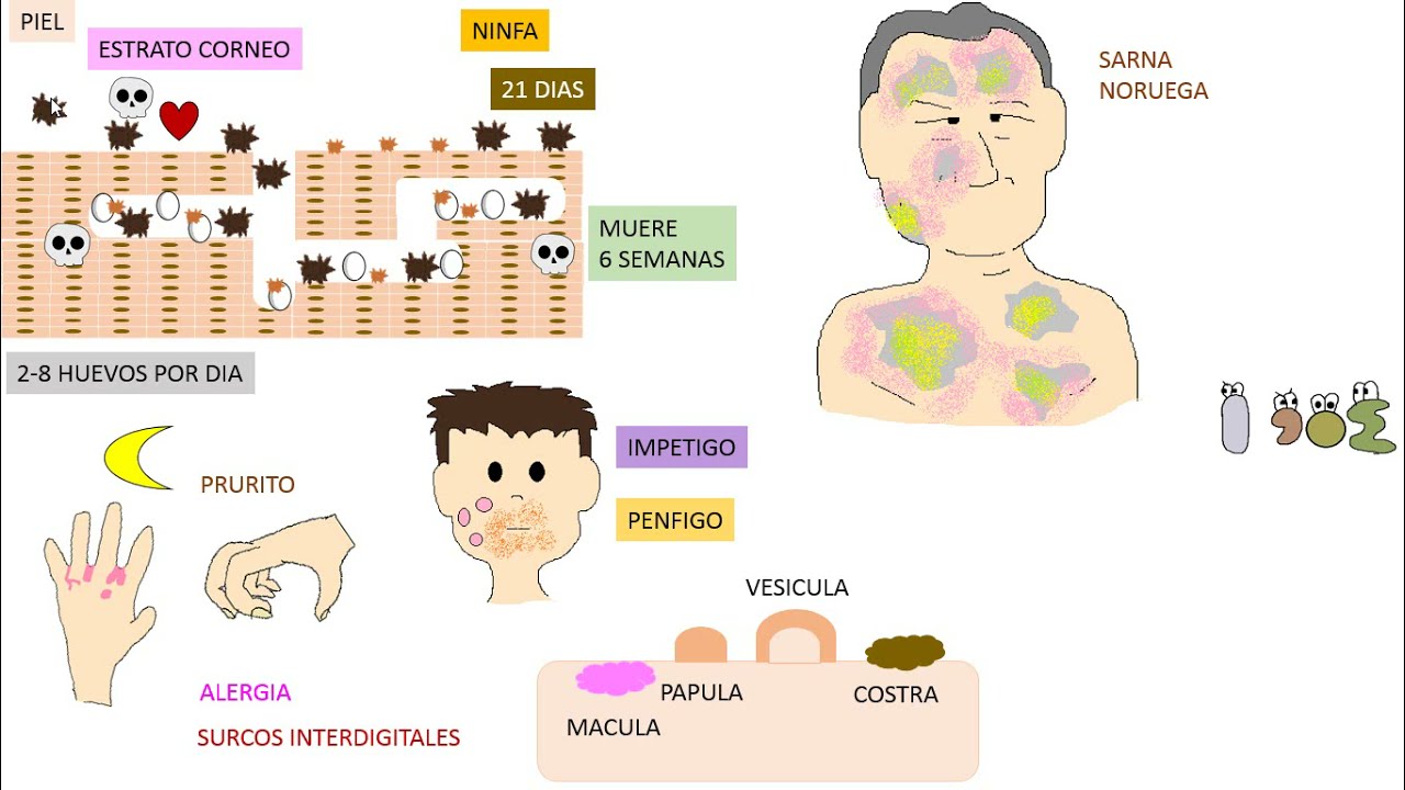 Sarna , Sarcoptes Scabiei