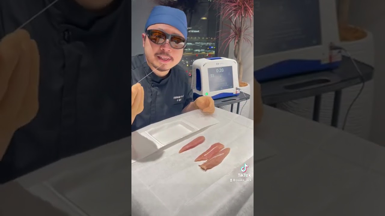 下肢静脈瘤血管内焼灼術➡️高周波vsレーザー
