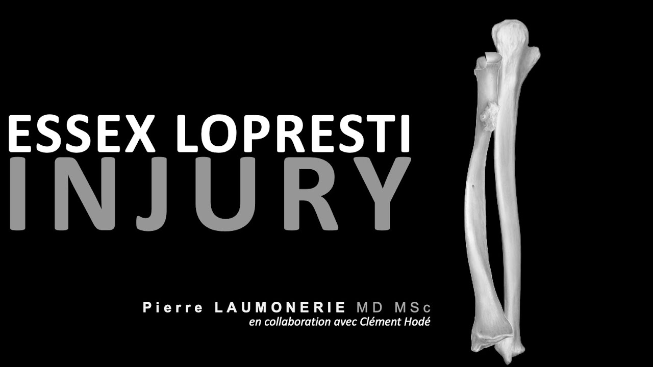 Lésion d'Essex Lopresti  - Essex Lopresti injury