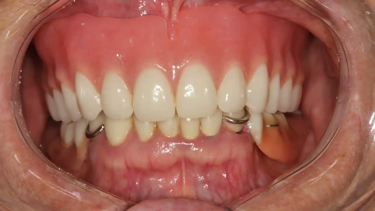 Digital Dentures: Revolutionizing the Process from Scan to Design to Delivery