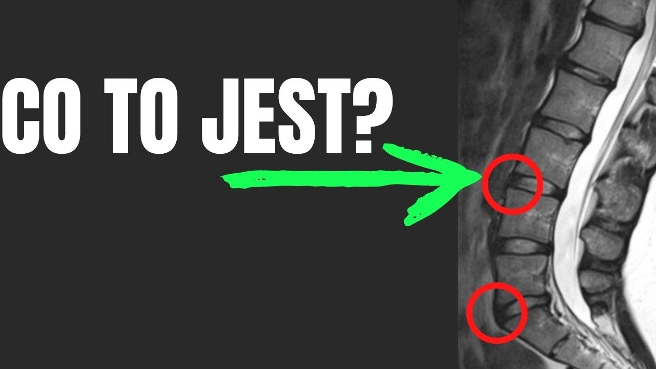 CO TO SĄ OSTEOFITY? JAK POWSTAJĄ I CZY SĄ GROŹNE?